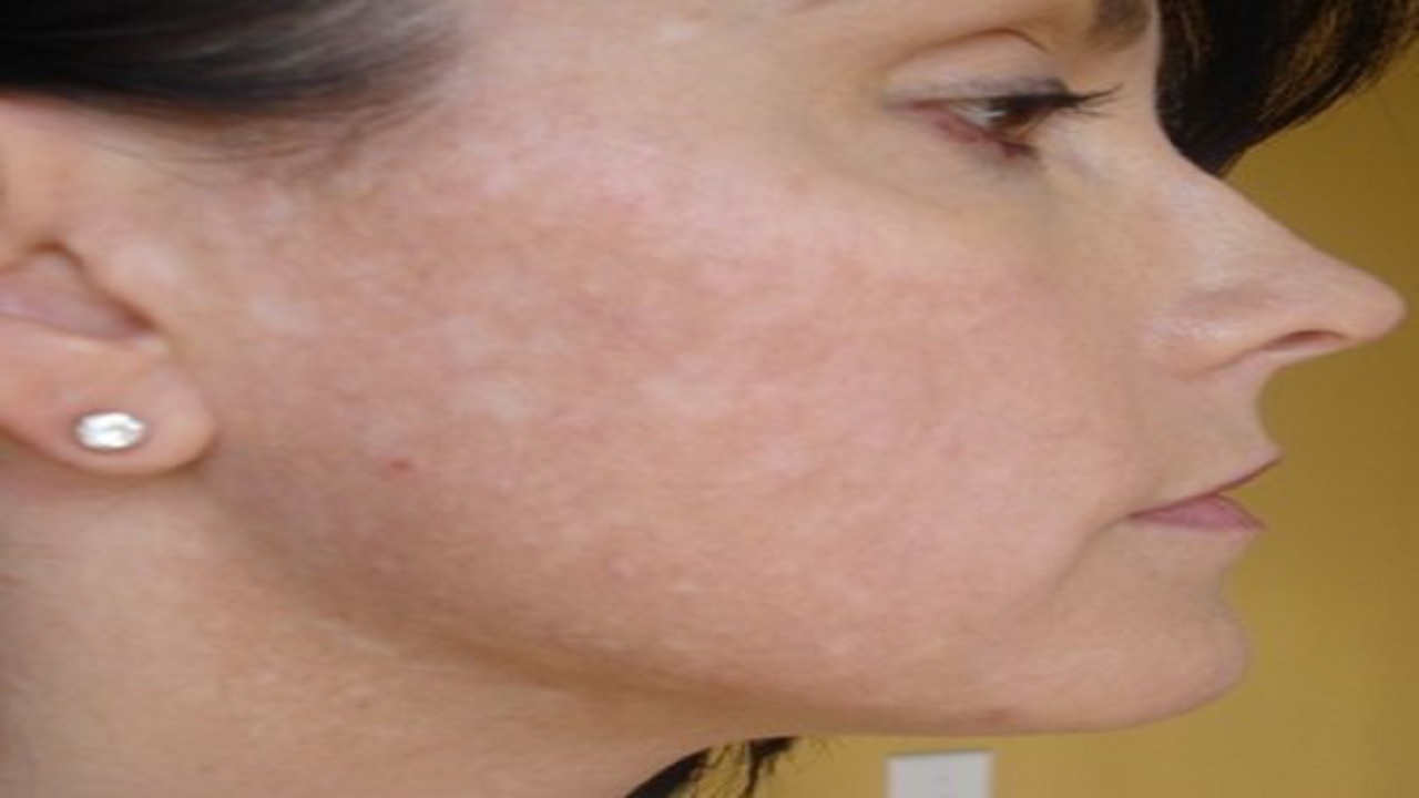 बरसात में त्वचा पर