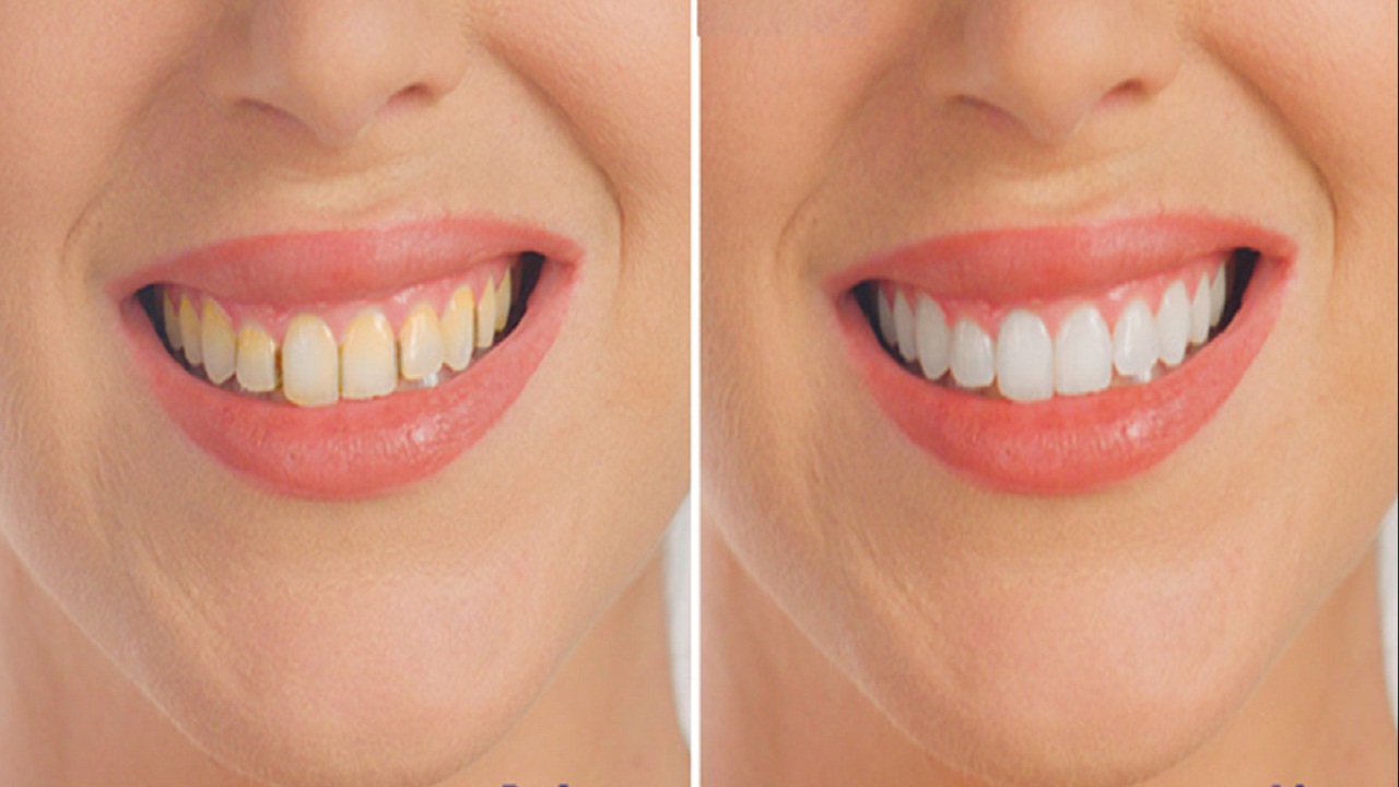 दांत से बदबू दूर