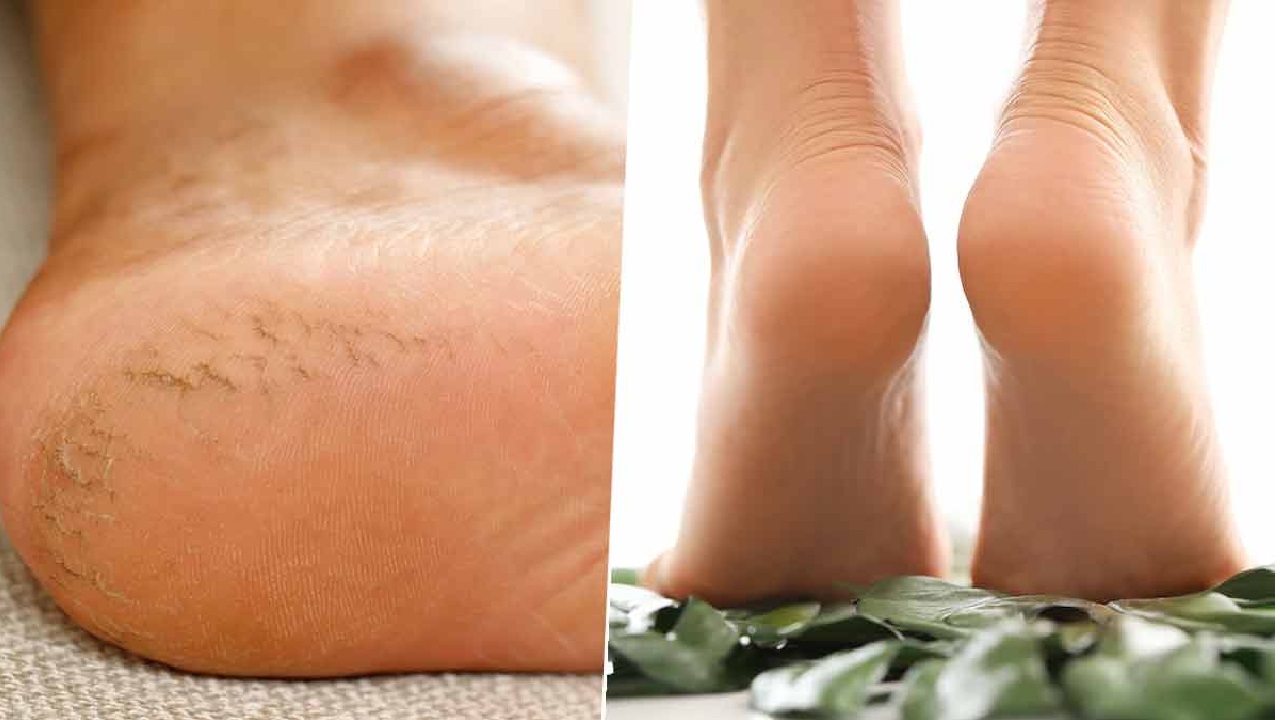 हैं फटे एड़ियों से