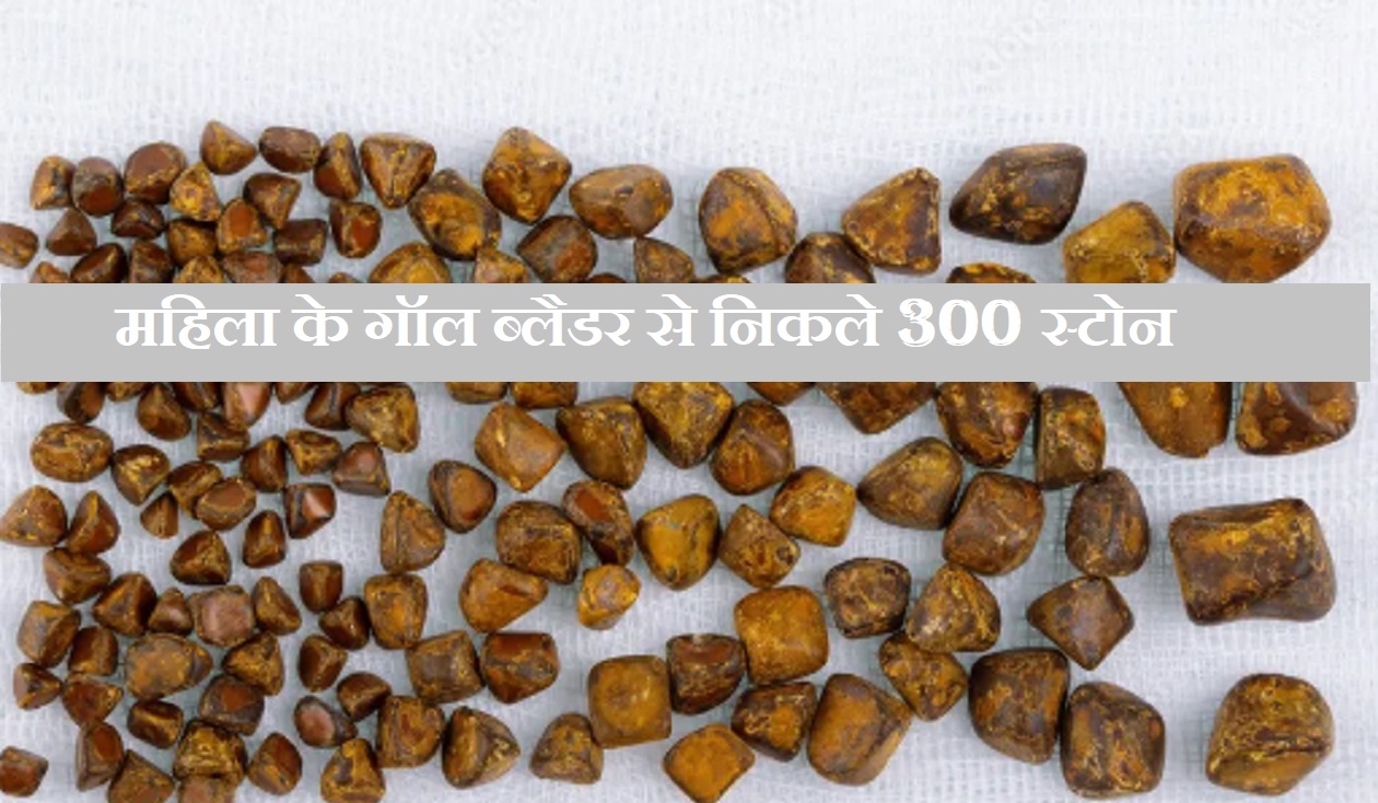 महिला के गॉल ब्लैडर