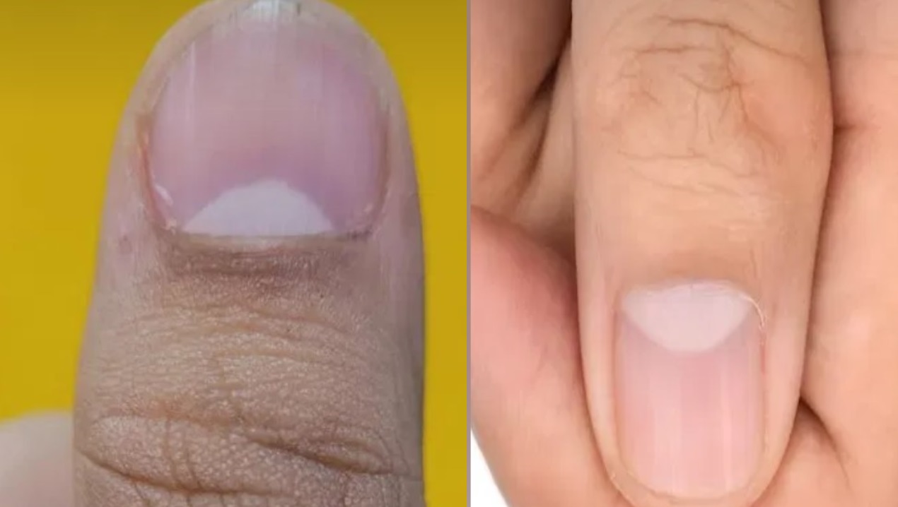 अंगूठे के नाखून में