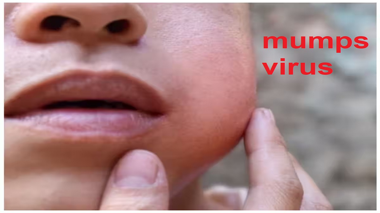 Mumps Virus: राजस्थान में