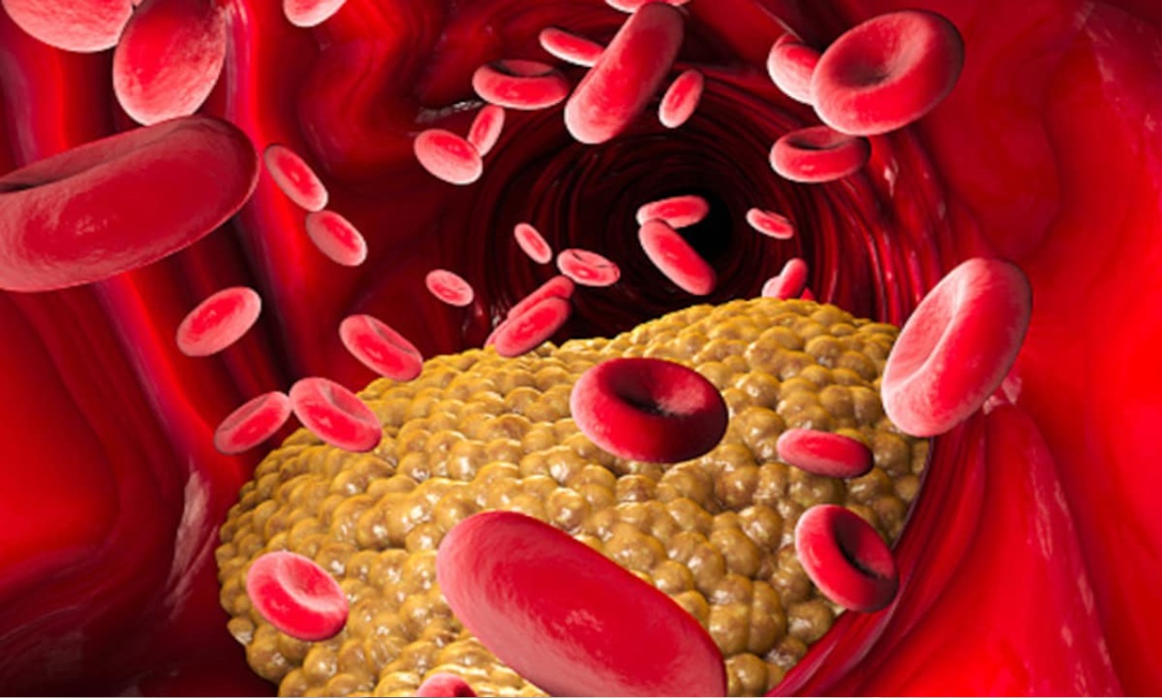 बैड कोलेस्ट्रॉल से हो